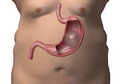 ballon gastrique