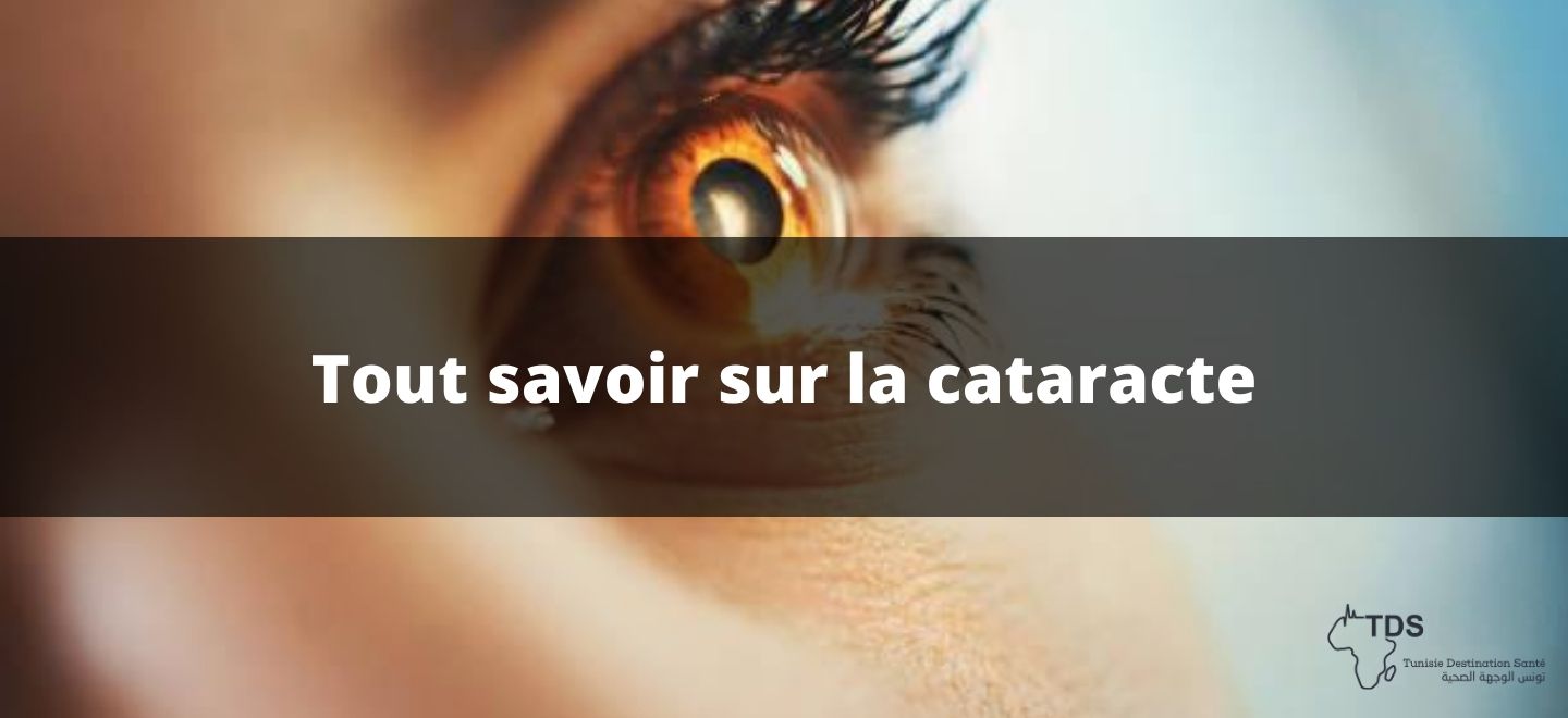 cataracte