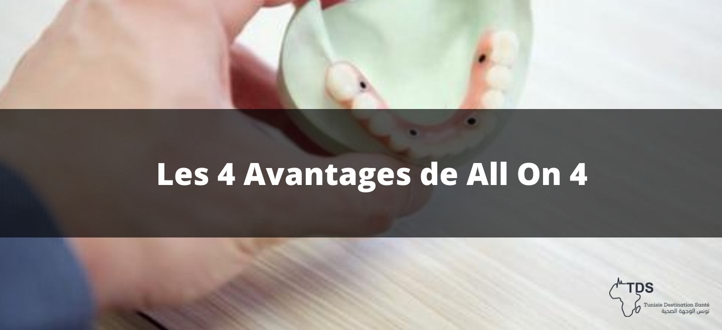 Les 4 Avantages de All On 4