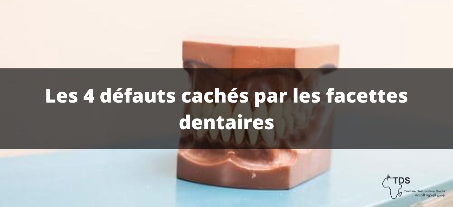 Les 4 défauts cachés par les facettes dentaires