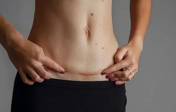 abdominoplastie
