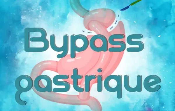 bypass