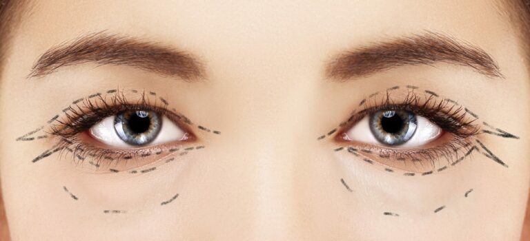 plus jeune grace a la blepharoplastie