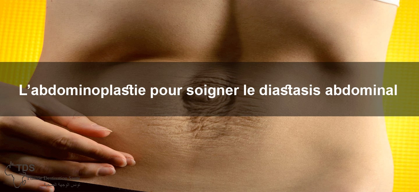 abdominplastie diastasis