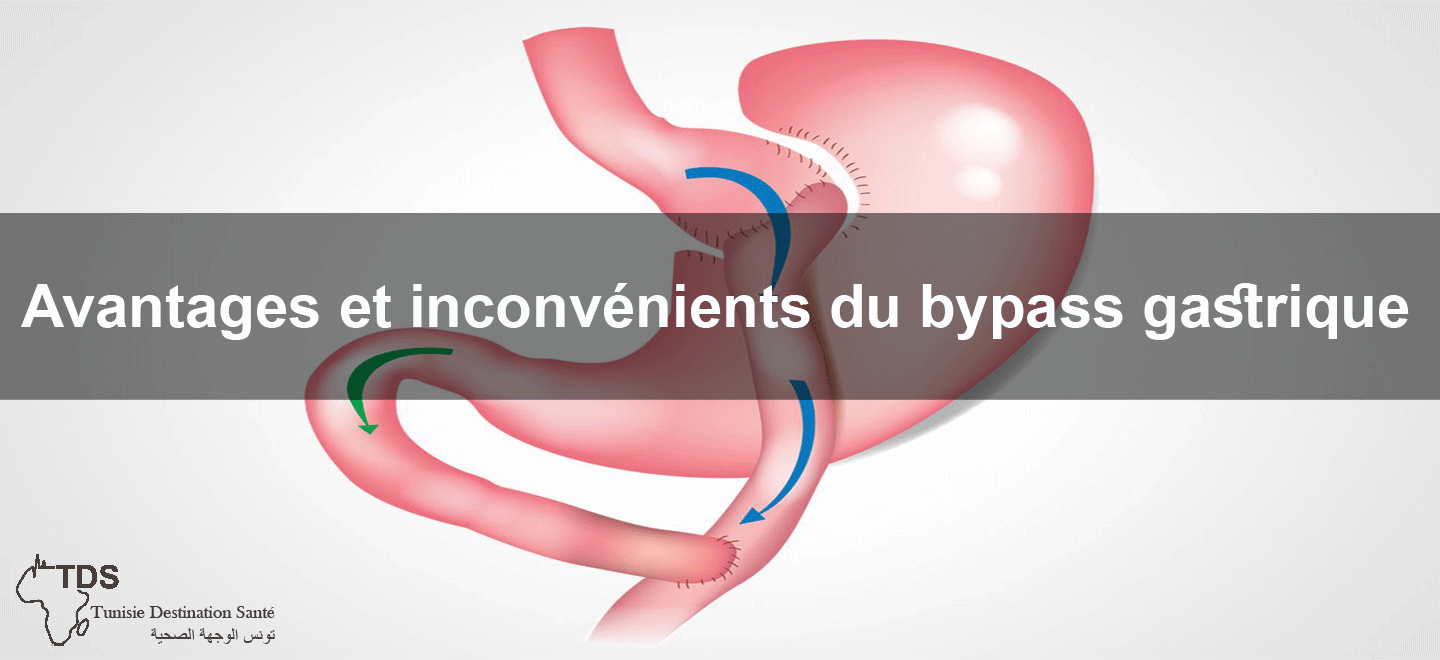 avantages-inconvenient-bypass-gastrique
