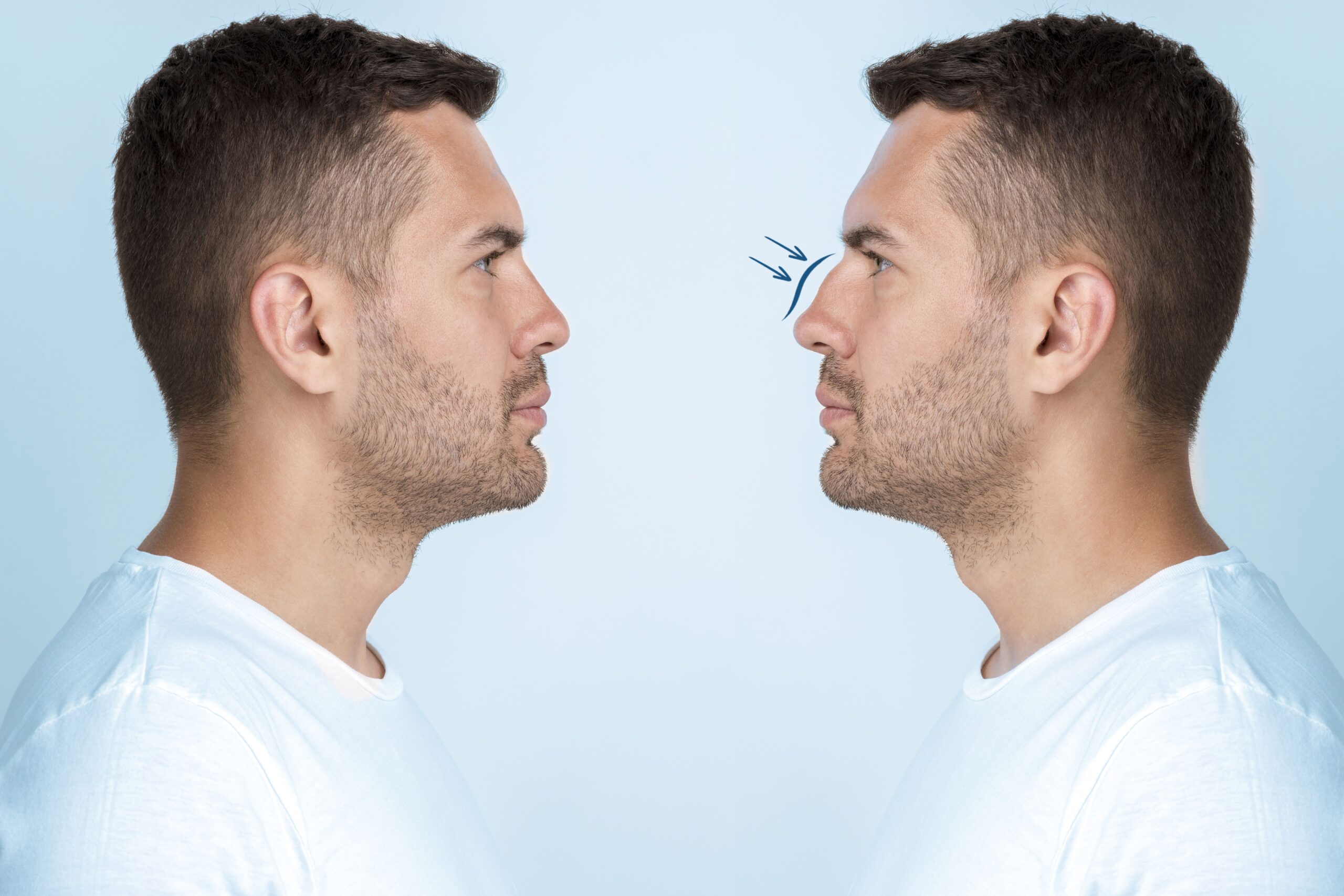 Rhinoplastie : chirurgie esthétique nez