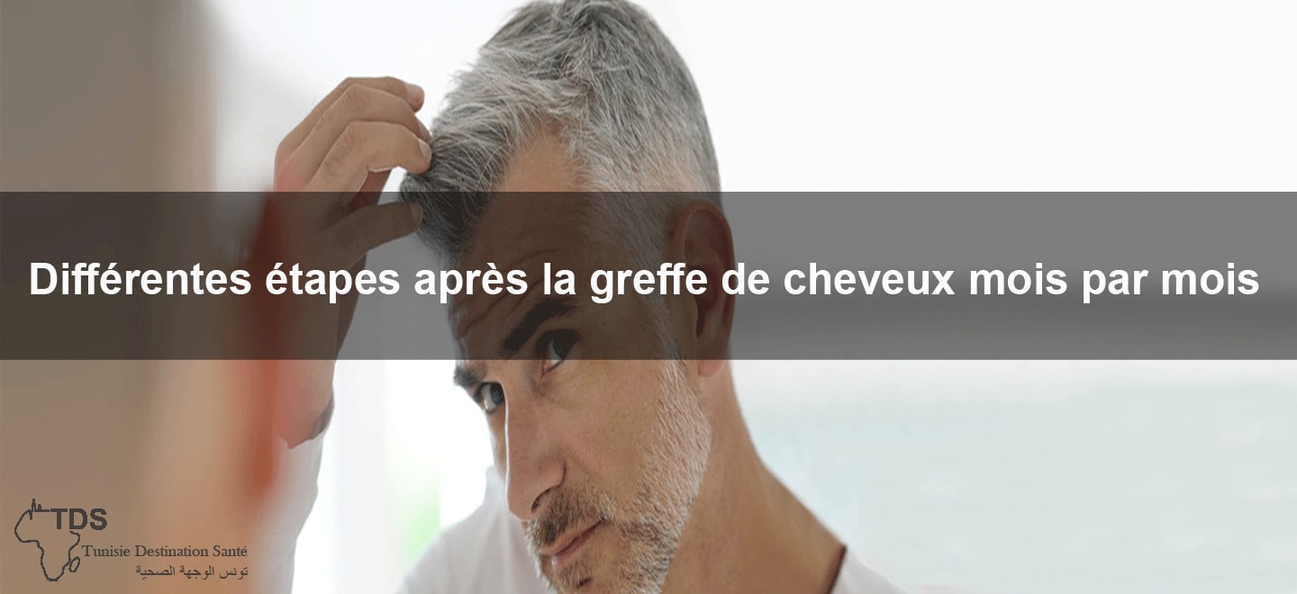 differentes etapes apres greffe cheveux