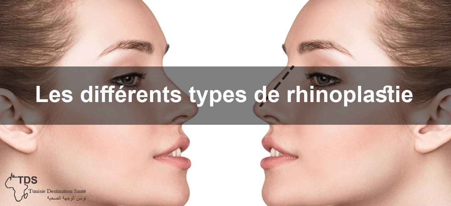 les differentes types rhinoplastie