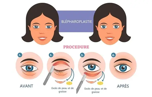 blépharoplastie