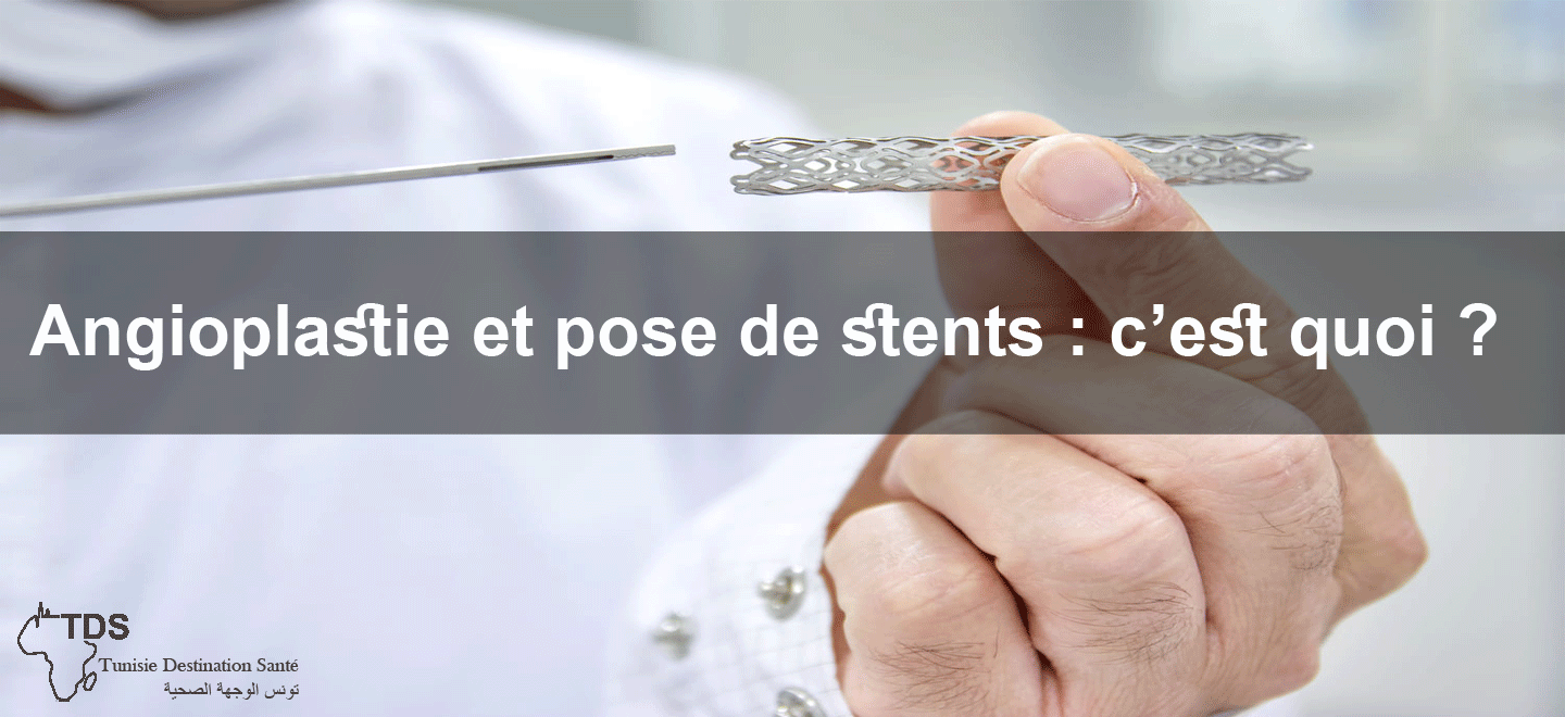 angiplastie-et-pose-stents