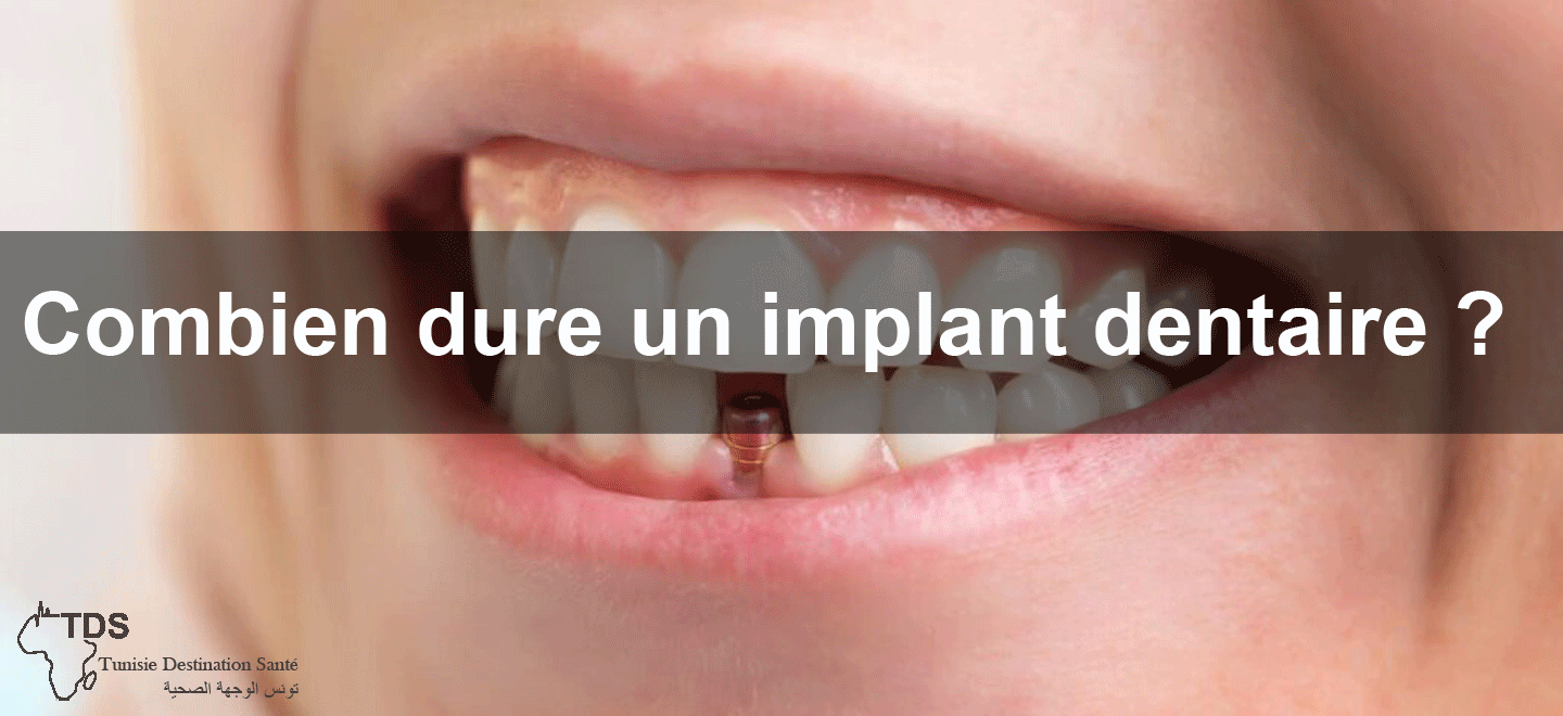 durée d'un implant dentaire
