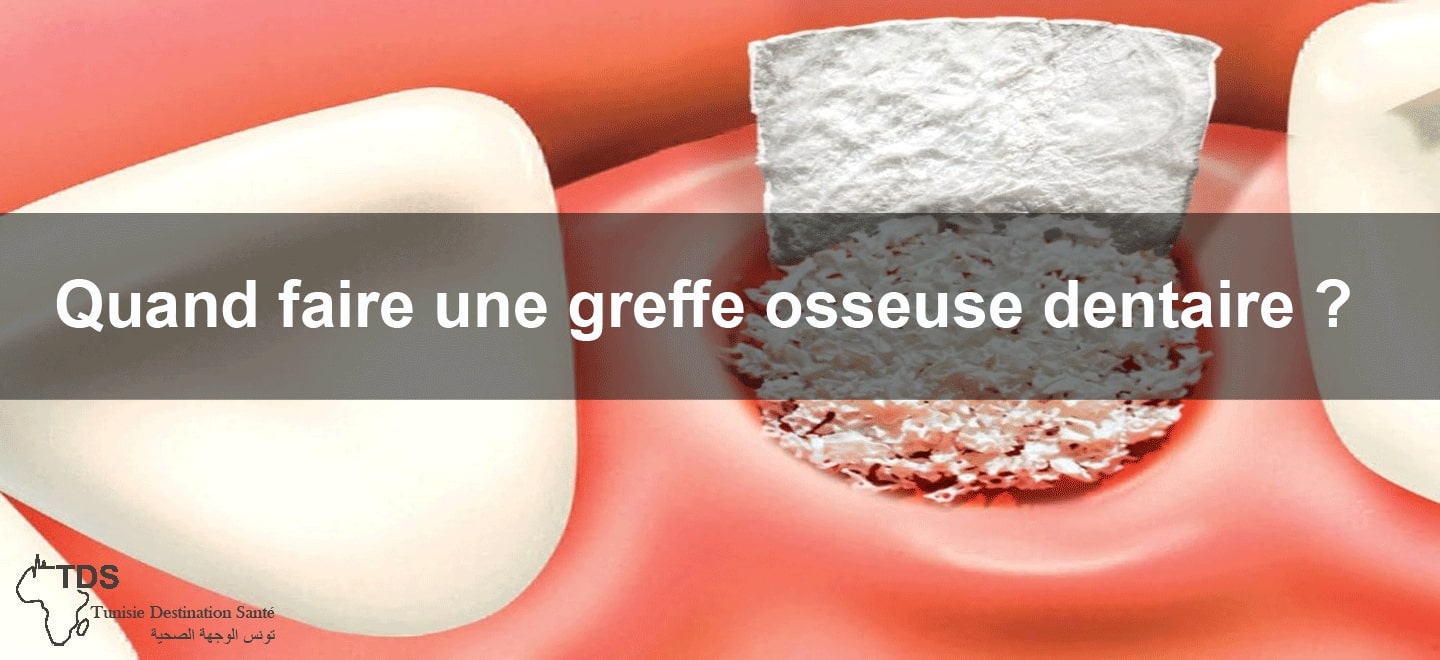 greffe osseuse dentaire