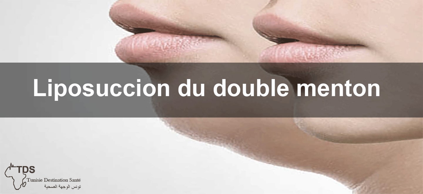 liposuccion du double menton