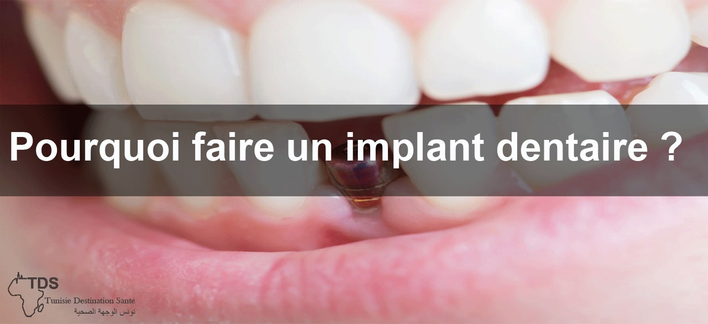 pourquoi faire implant dentaire