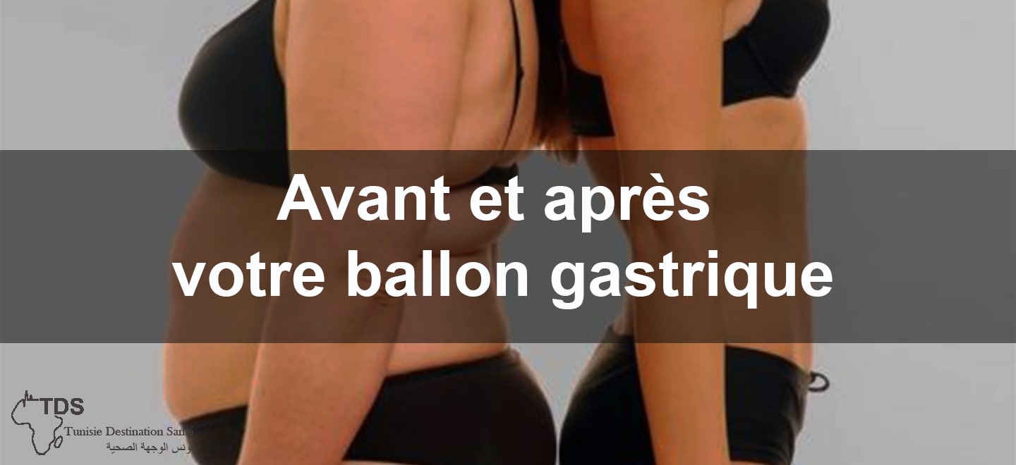 un ballon gastrique