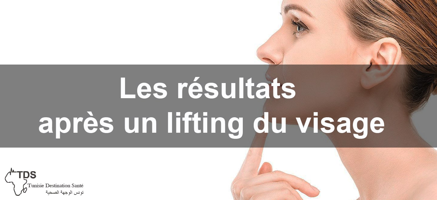 Les resultats apres un lifting du visage