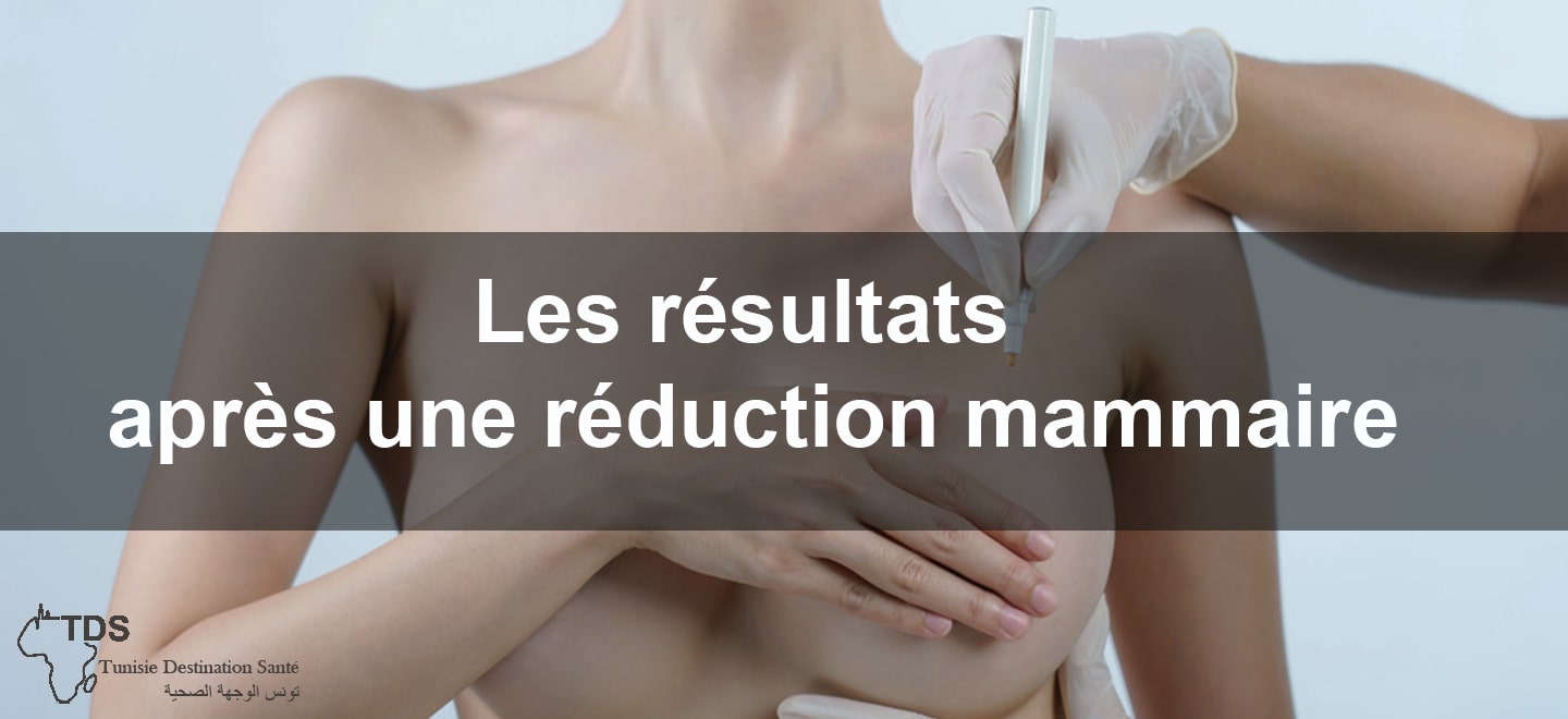 Réduction mammaire