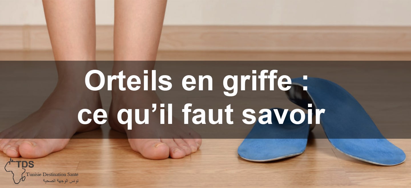 Orteils en griffe ce qu il faut savoir