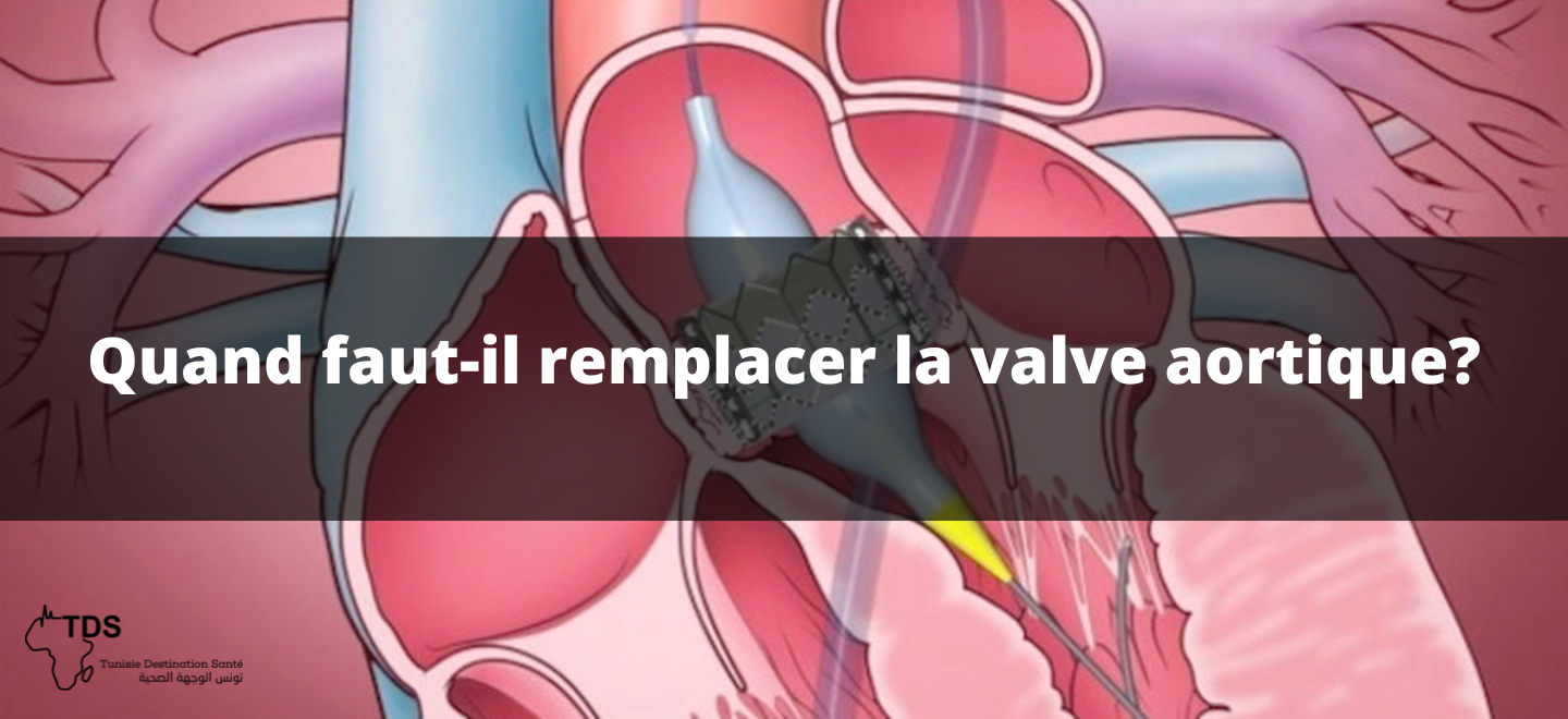 valve aortique