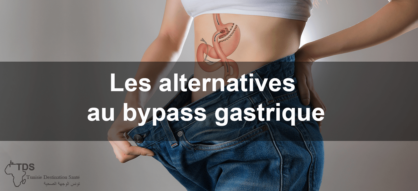 alternatives au bypass gastrique