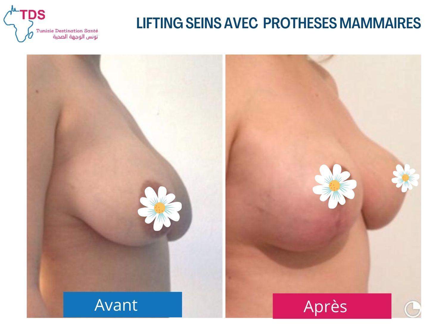 résultat avant après augmentation mammaire avec lifting