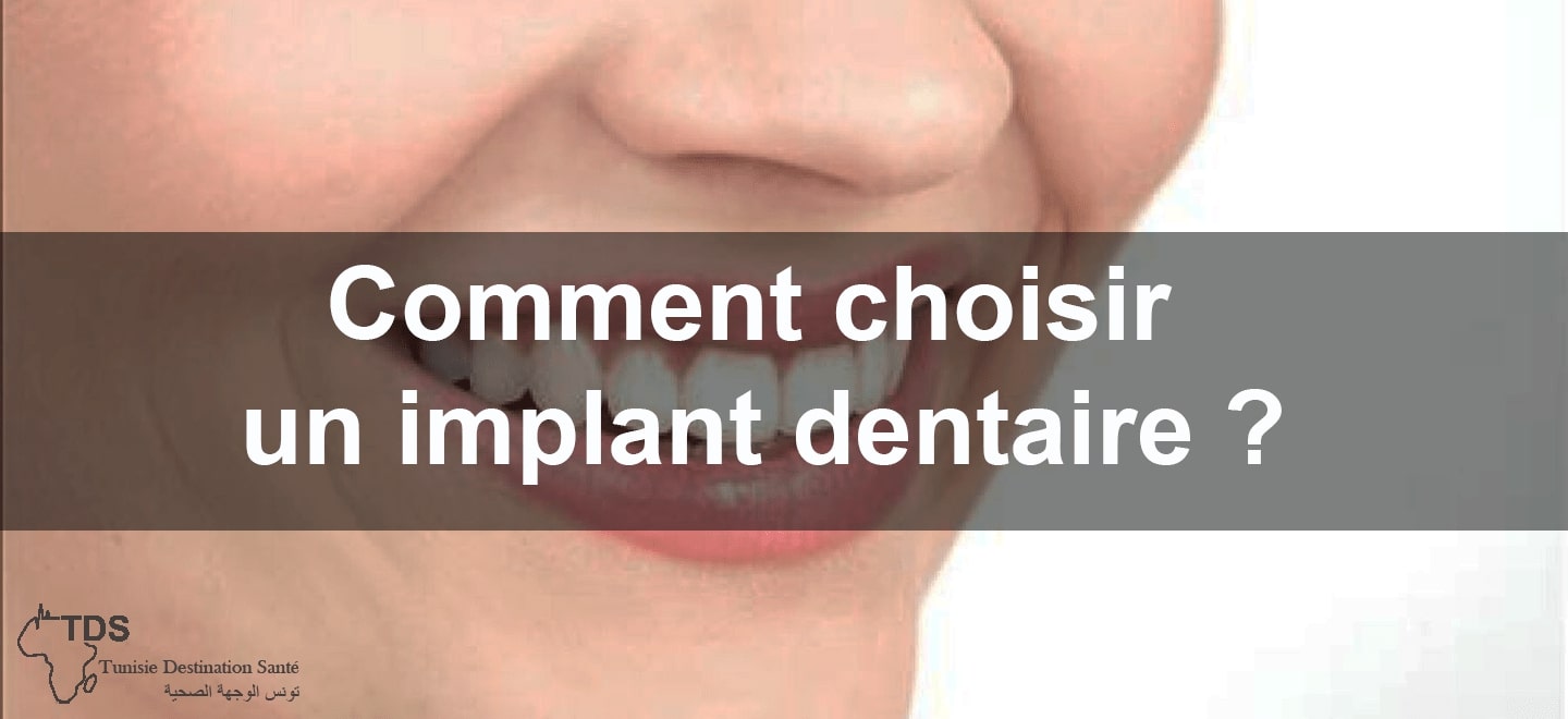 choisir un implant dentaire