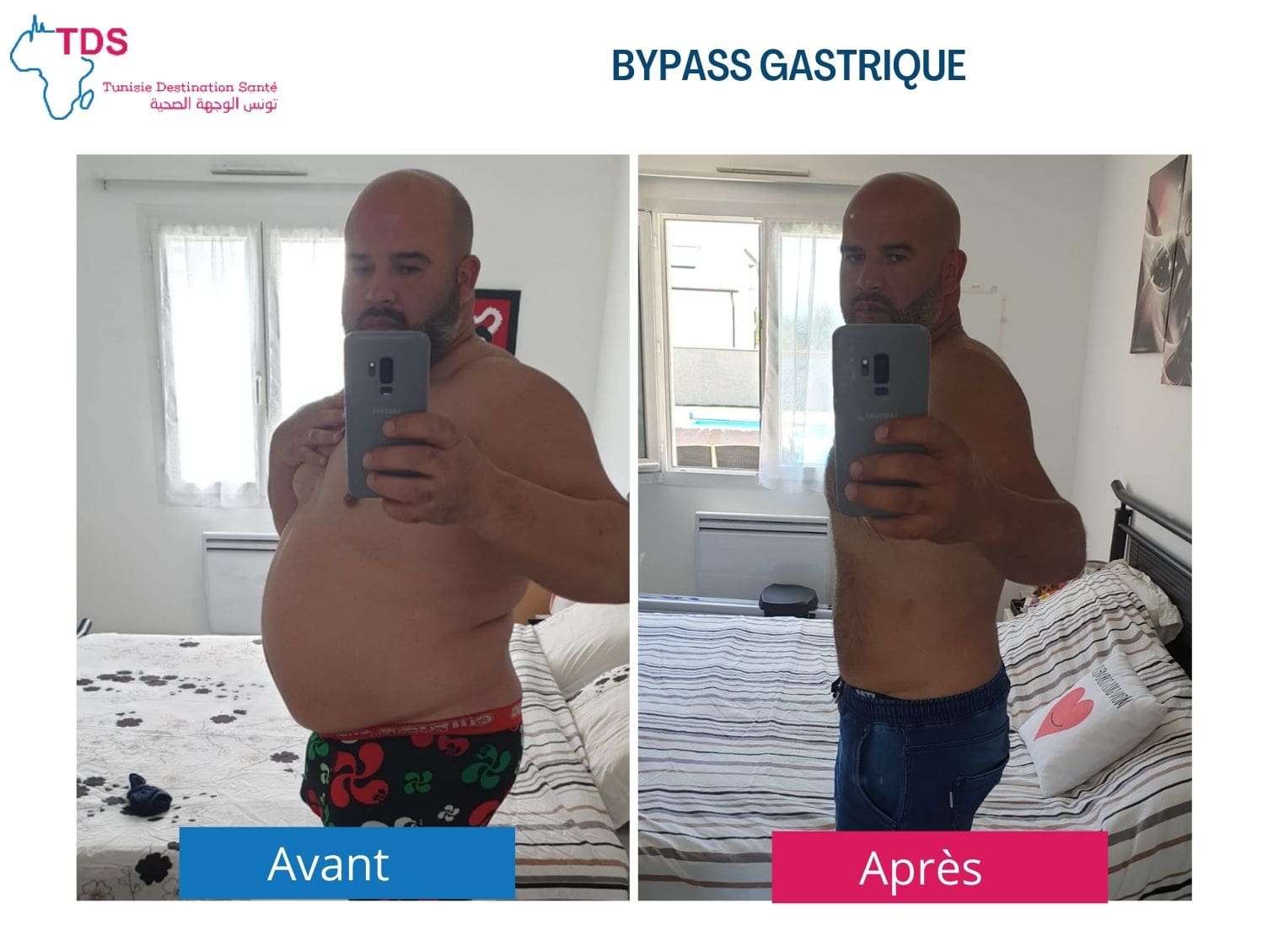 résultat bypass avant après