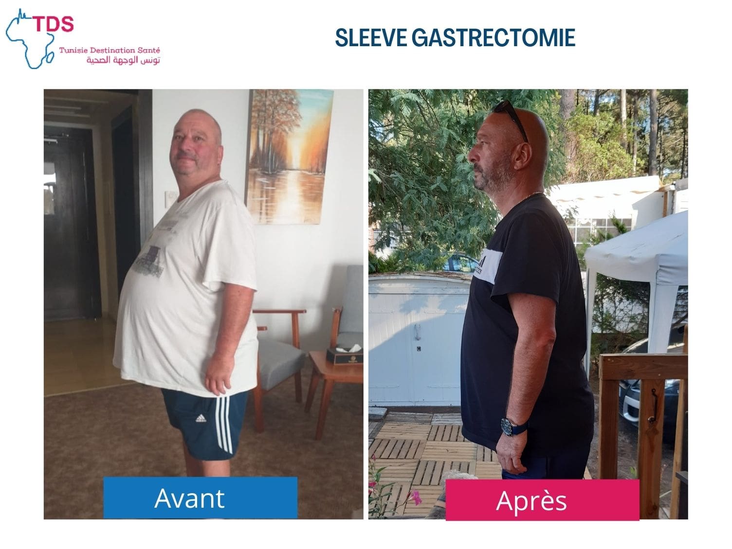résultat sleeve avant après