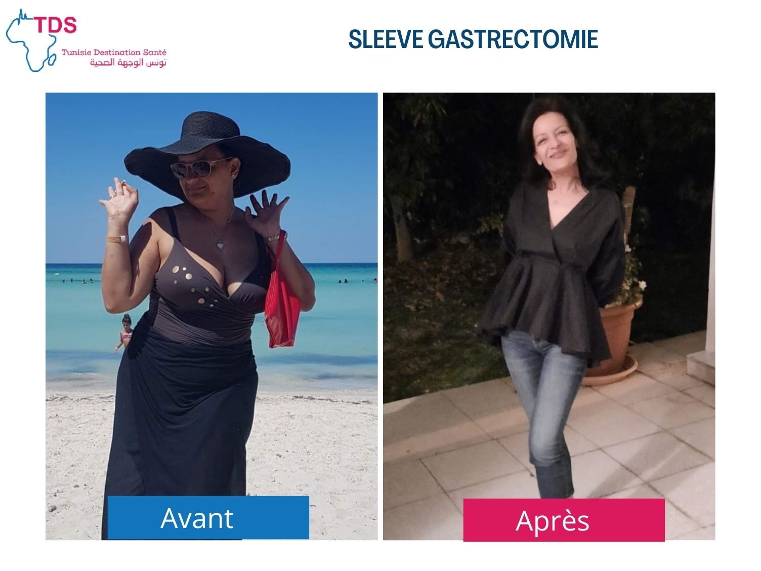 résultat sleeve avant après