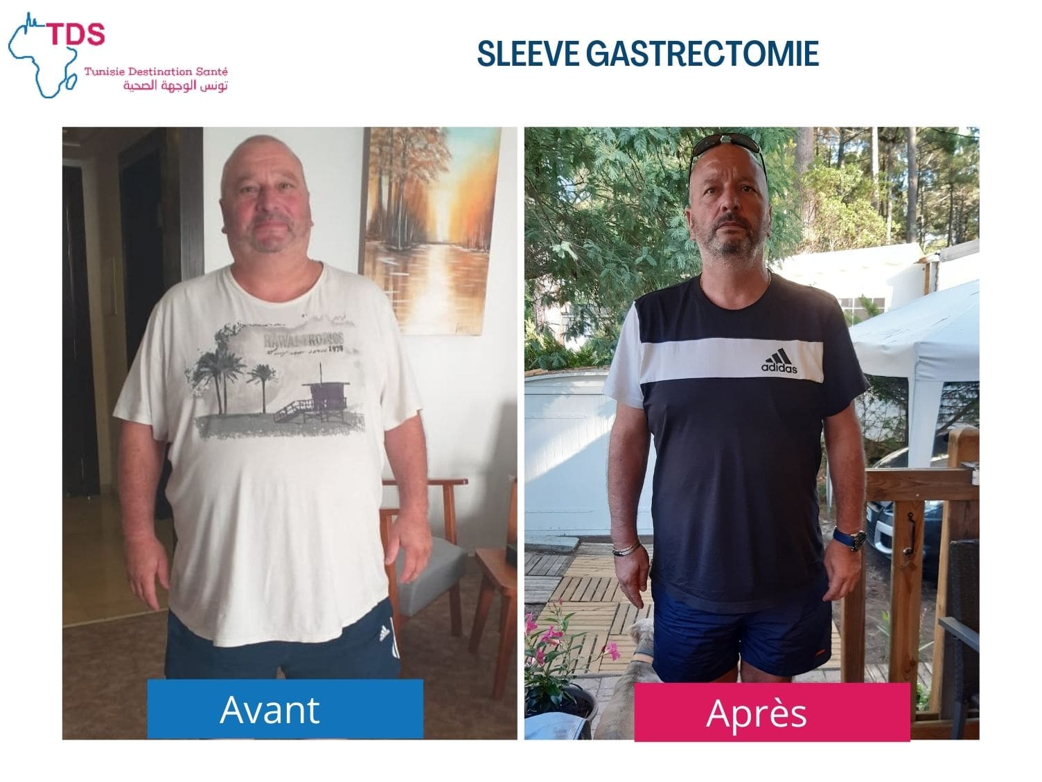 résultat sleeve avant après