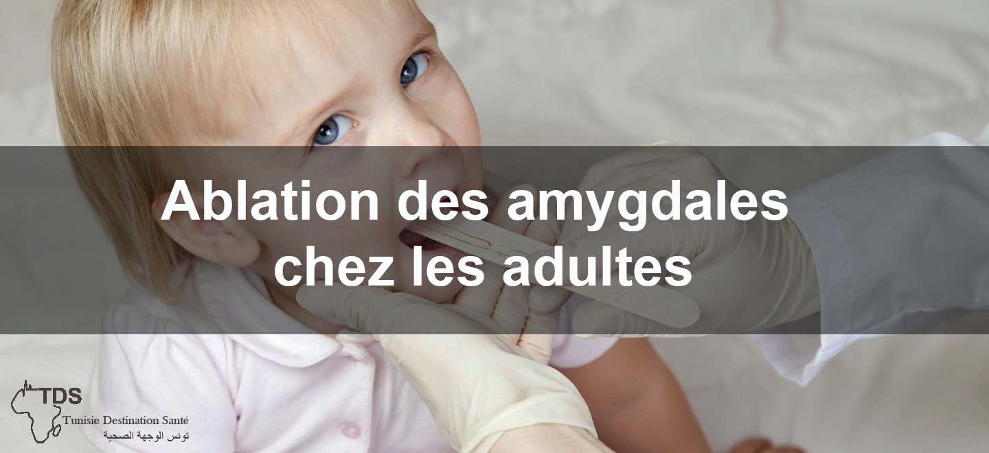 Ablation des amygdales chez les adultes