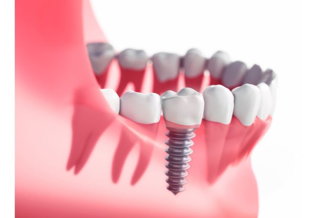 traitement implant dentaire