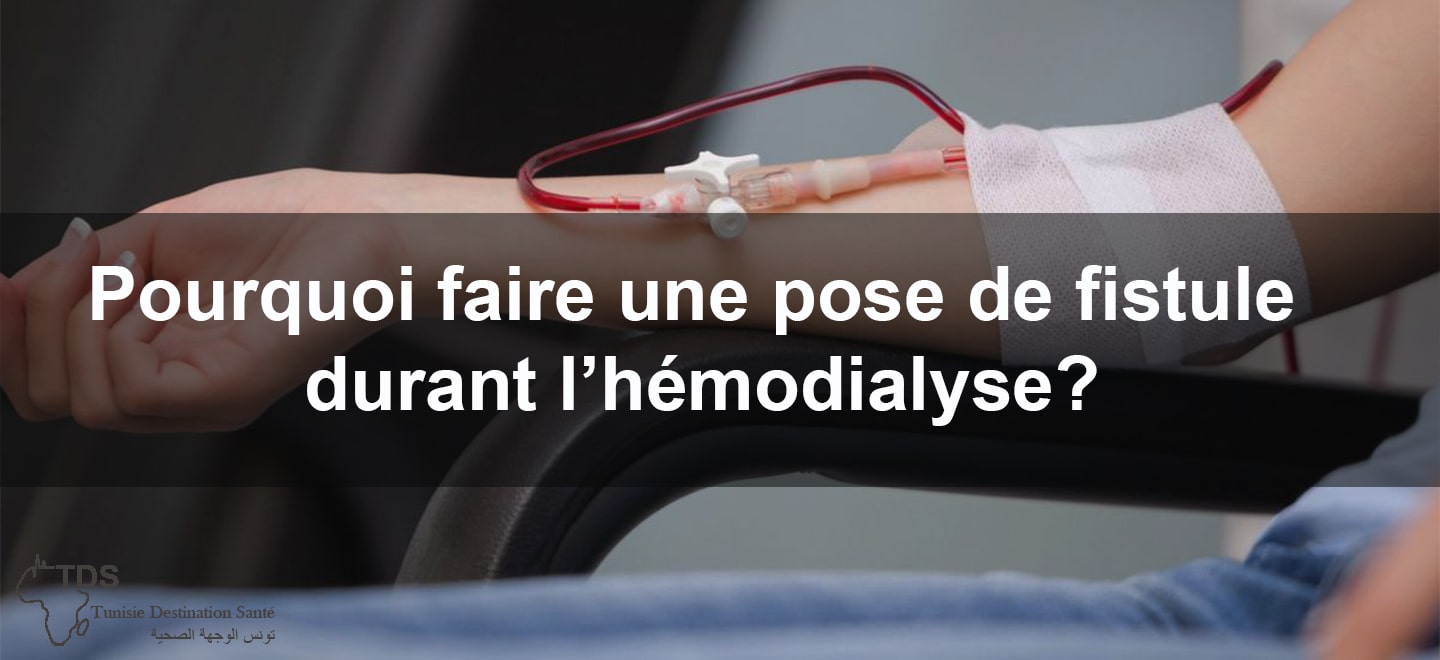 Pourquoi-faire une pose de fistule durant lhemodialyse