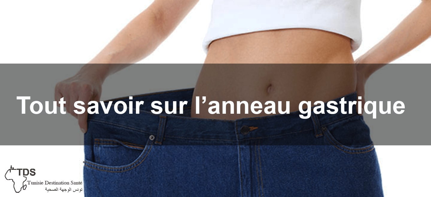 savoir sur l'anneau gastrique