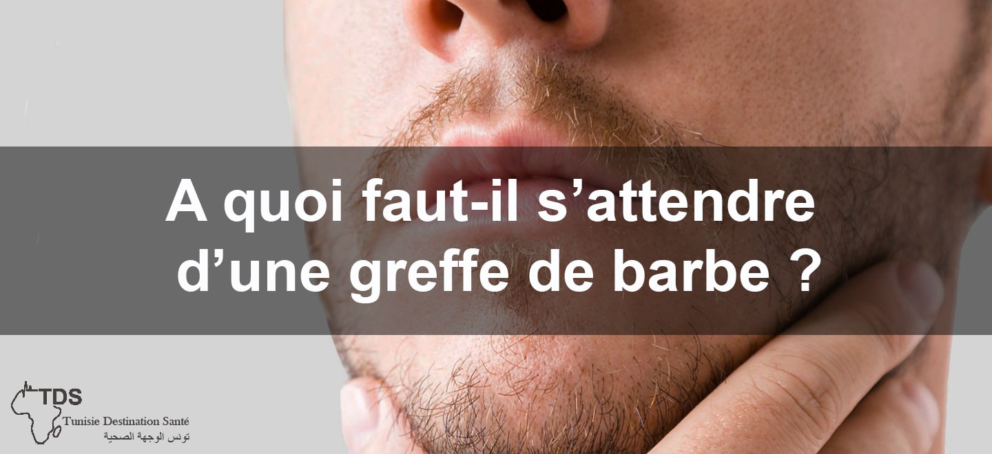 A quoi faut il sattendre d une greffe de barbe