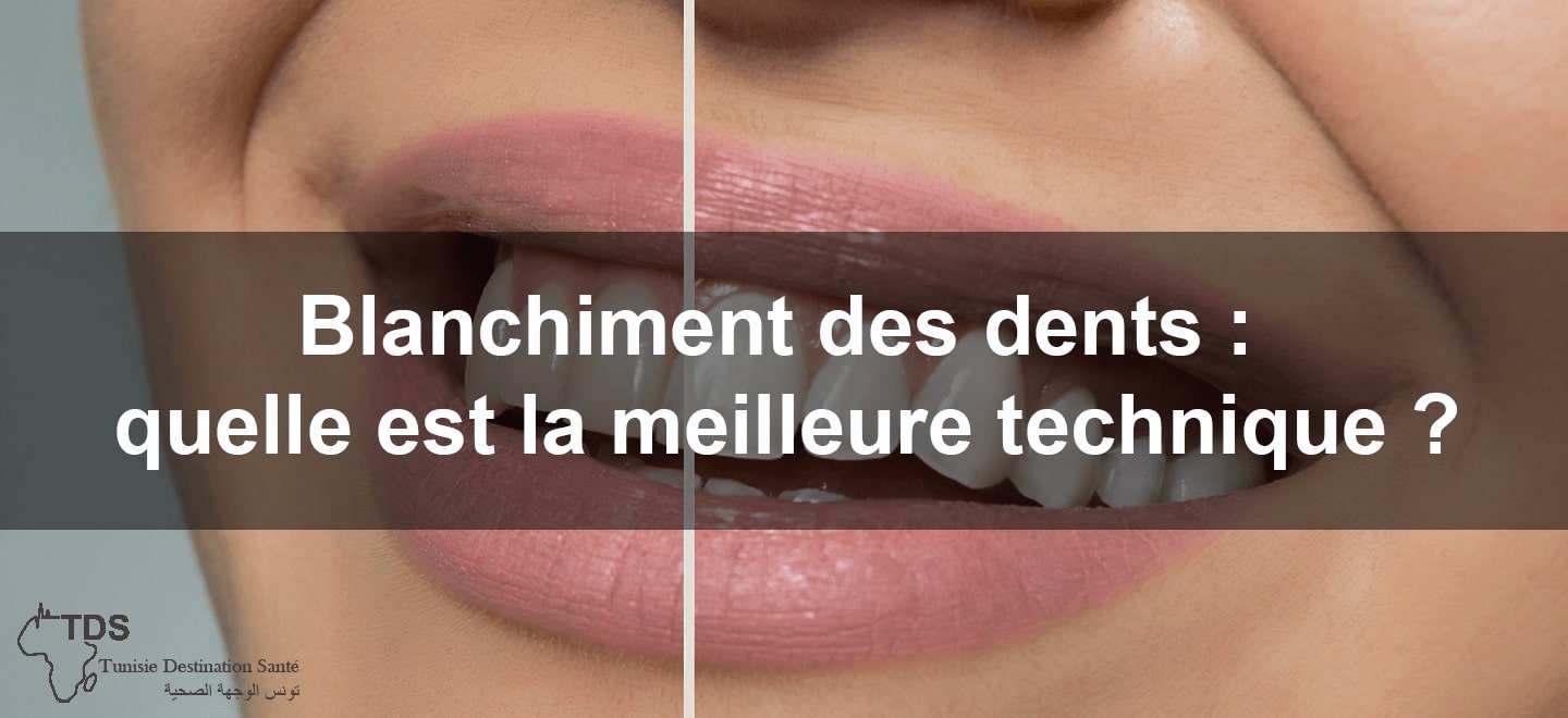 blanchiment des dents meilleure technique