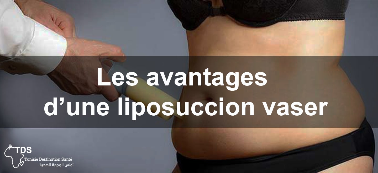 Liposuccion vaser