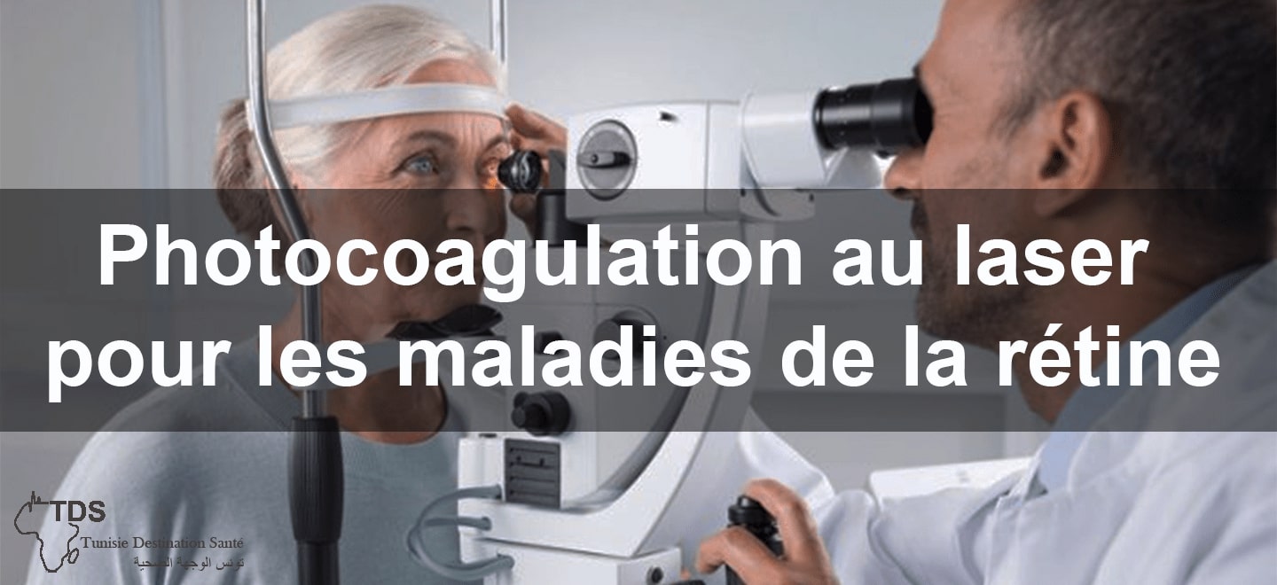 Photocoagulation laser retine