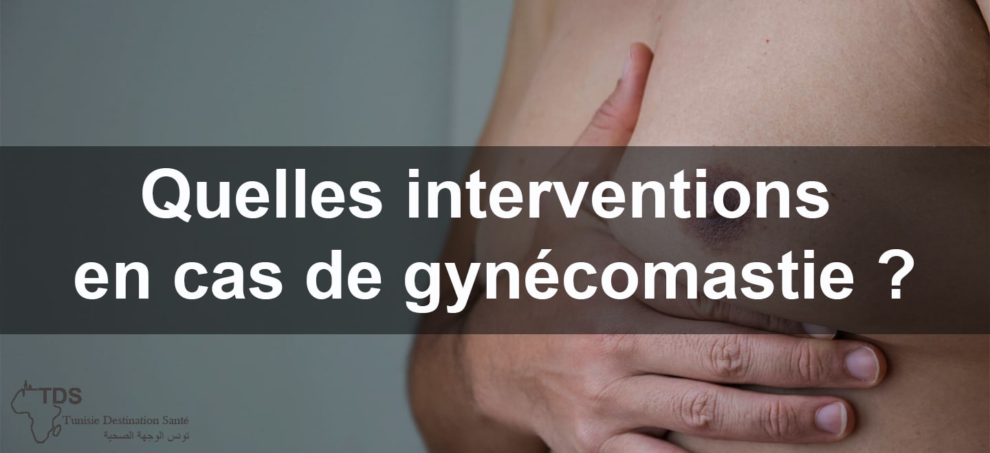 Quelles interventions en cas de gynecomastie