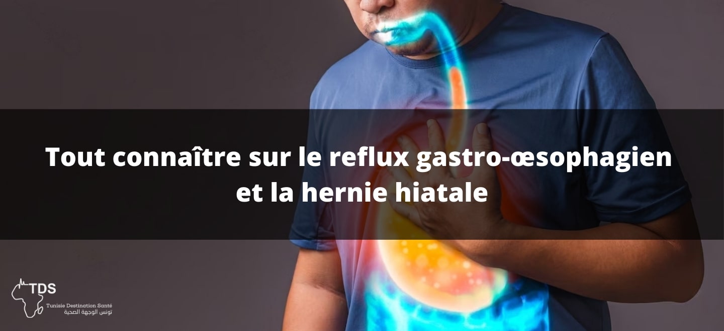 Tout connaître sur le reflux-gastro œsophagien et la hernie hiatale