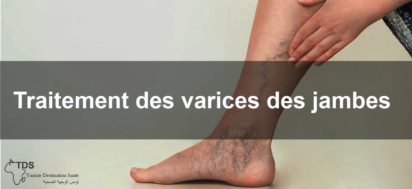 Traitement des varices