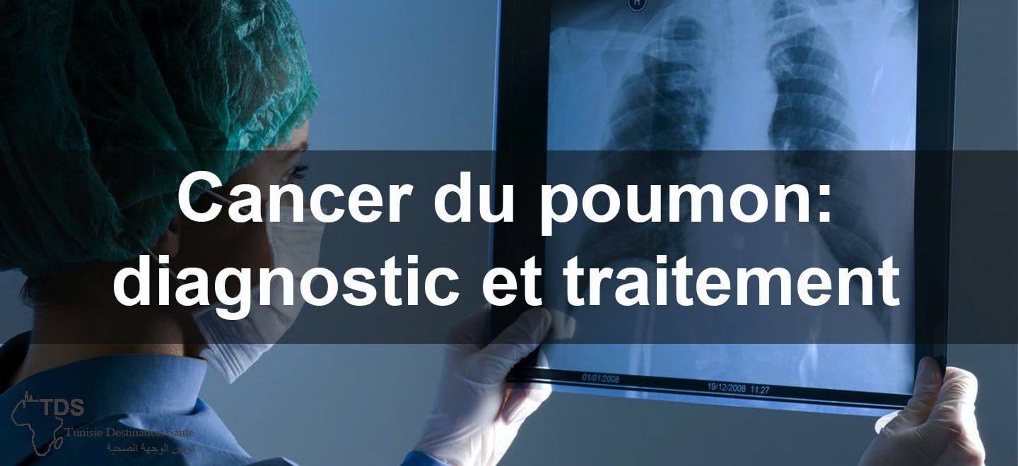 cancer du poumon : diagnostic et traitement