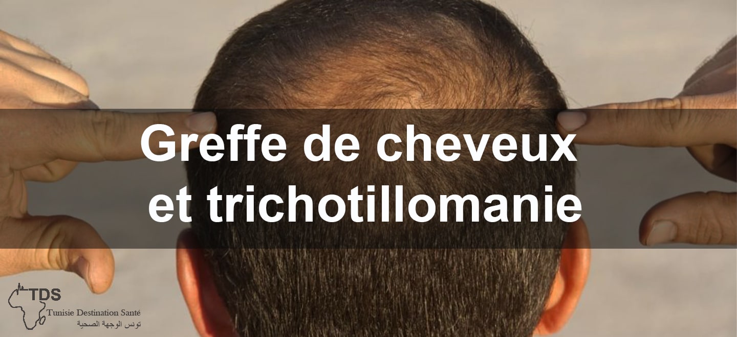 Greffe de cheveux et trichotillomanie