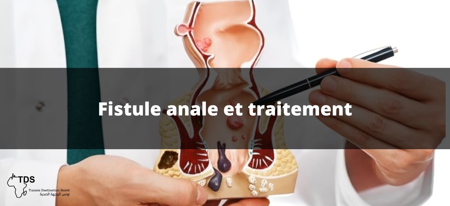 Fistule anale