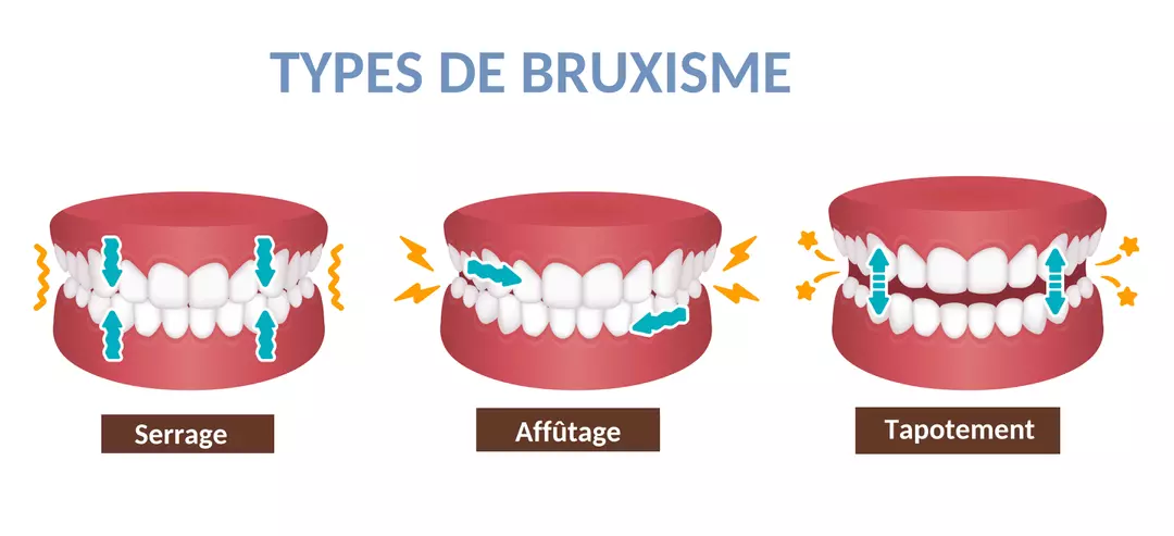 Types bruxisme dentaire