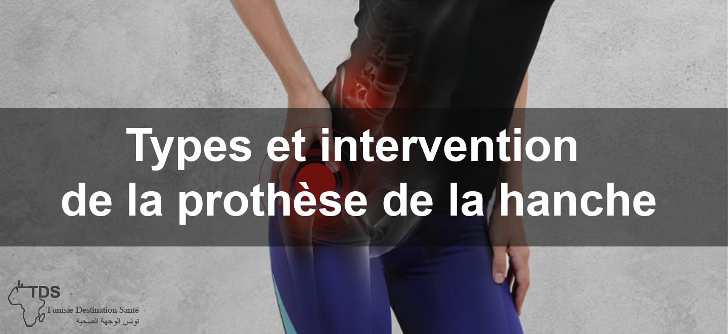 Types et intervention de la prothese de la hanche
