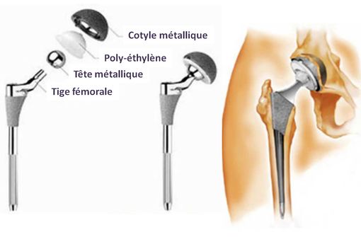 Prothèse hanche