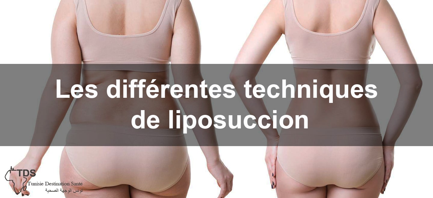 La liposuccion du visage