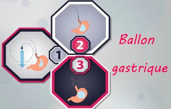 ballon gastrique