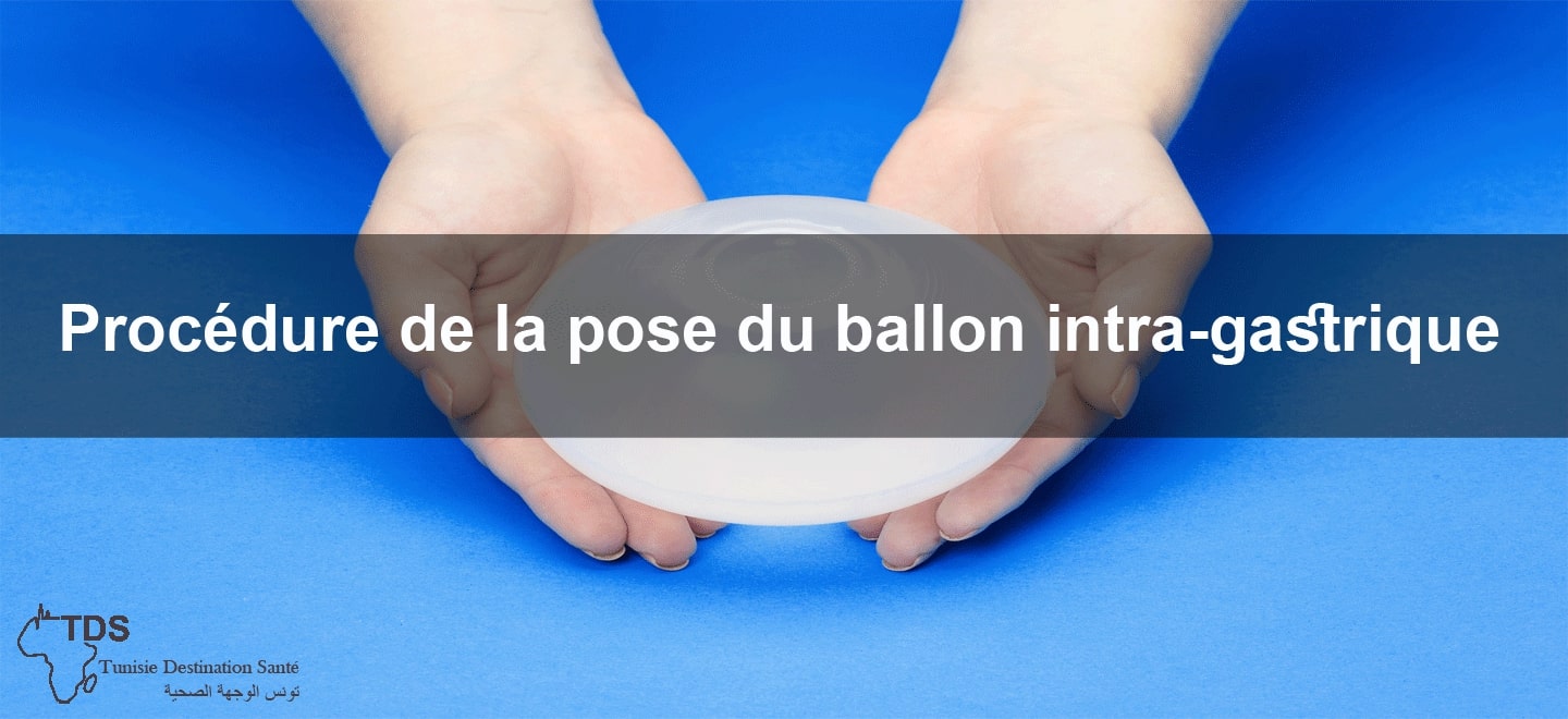 ballon intra-gastrique